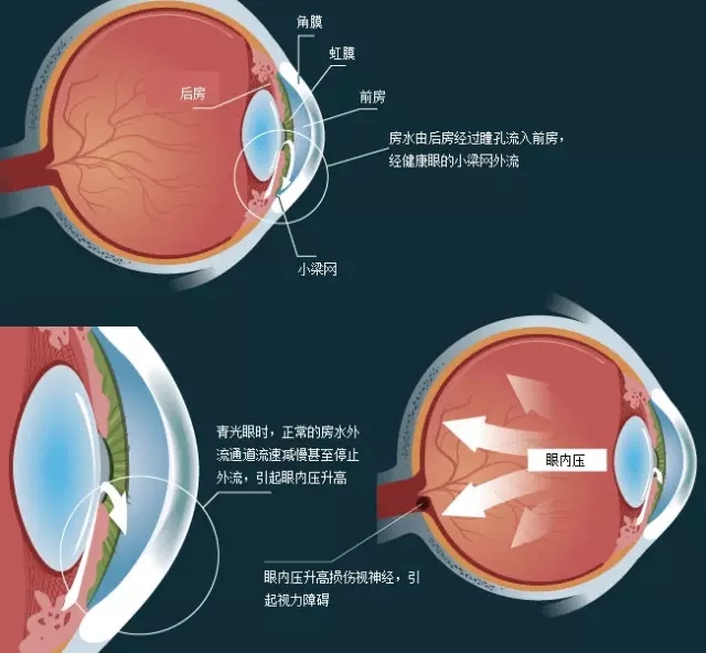 各類(lèi)型青光眼原則