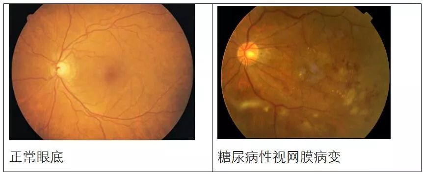 患了“糖尿病”后，該做哪些眼科檢查？