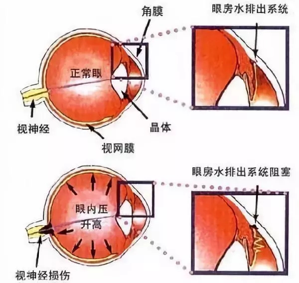 頭暈眼花，不一定是感冒，還可能是眼疾！